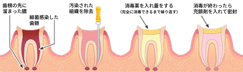根管治療の流れ
