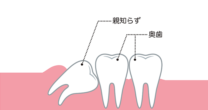 親知らず
